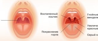 Ангина при гв