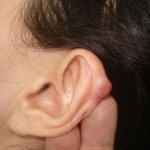 Атерома на ухе