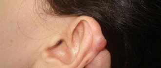 Атерома на ухе