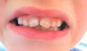 Белые пятна на зубах у ребенка фото