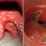 болит горло гнойные выделения