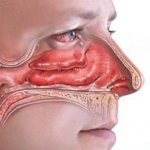 Болячки в носу: этиология и причины, симптоматика, лечение