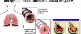 Бронхоспазм. Симптомы у детей, взрослых, что это такое, причины, как снять, лечение
