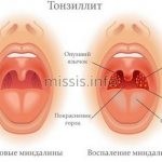Что такое тонзиллит
