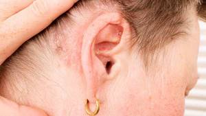 дерматит в области уха