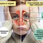 гайморит у детей