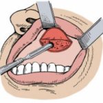 Гайморотомия