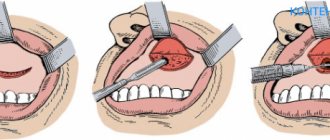 Maxillary sinusotomy