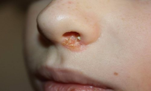 Герпес в носу встречается реже, чем простуда на губах, вызванная вирусом, так как подобное проявление болезни является результатом отсутствия лечения более легких форм течения патологии