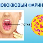 Гонорейный фарингит симптомы