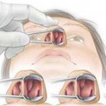 Как проводится вазотомия носовых раковин — отзывы после операции