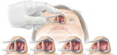 Как проводится вазотомия носовых раковин — отзывы после операции