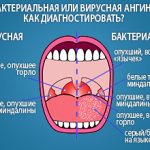 Как различить бактериальную ангину от вирусной