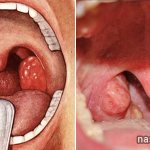 How to cure hypertrophied tonsils