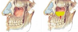 Катаральный гайморит может развиваться из-за воспаления в зубах верхней челюсти