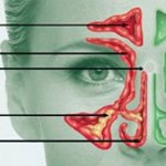 Классификация (виды) синусита