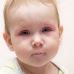 Красные глаза у маленького ребенка
