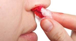 Кровь из носа при беременности первый-второй-третий триместр. Что делать