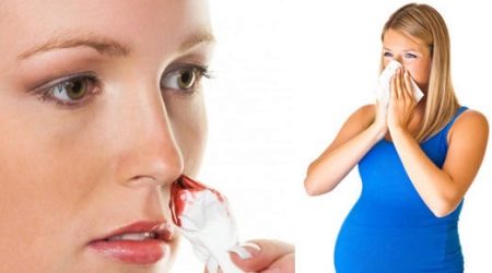 Кровь из носа при беременности третий триместр
