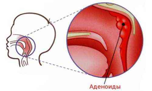 Лечение протарголом при аденоидах