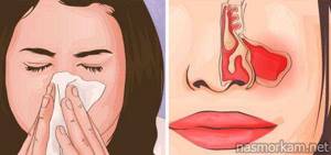 Лечение воспаления носа народными средствами
