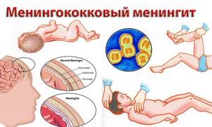 Менингококковая инфекция у детей симптомы