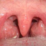 миндалины у ребенка