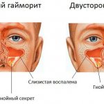is it possible to die from sinusitis
