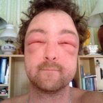 Мужчина с выраженной аллергией