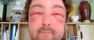 Мужчина с выраженной аллергией