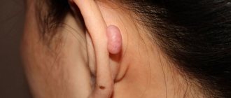 Нарост на ухе у человека: причины, симптомы, лечение