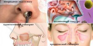 Однородные тела в носу, полипозный синусит, одонтогенный и хронический гайморит