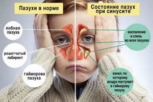острый синусит у детей симптомы и лечение