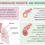 Откуда появляется бронхиальная мокрота в лёгких