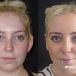 Отопластика повышает самооценку пациента