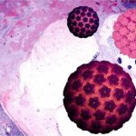 Папиллома в горле: симптомы, лечение и операция по удалению