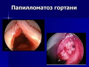 Папиллома в горле: симптомы, лечение и операция по удалению