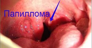 папилломатоз горла