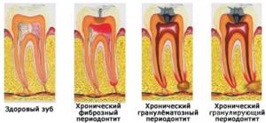 Периодонтит - такая болезнь может вызывать боли в челюсти