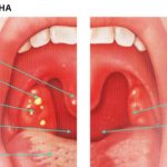 Первые признаки и симптомы заболевания