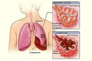 Пневмония и кашель