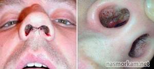 Почему образуются кровавые корки в носу