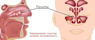 Полипозный синусит