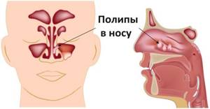 Полипы в носу у ребенка: симптомы и лечение, а также диагностика и лекарства