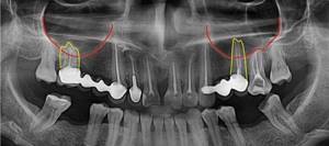 При гайморите болят зубы: почему и что делать?