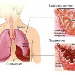 Признаки пневмонии у взрослого без температуры с кашлем