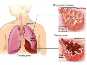 Признаки пневмонии у взрослого без температуры с кашлем