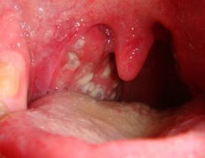 признаки сифилиса во рту