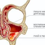 Manifestation of rhinosinusitis