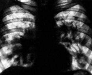 Рентгенограмма при двусторонней пневмонии